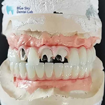 kopen Titanium Malo brug Implantatie brug zonder meervoudige eenheid abutment cementerable online manufacture
