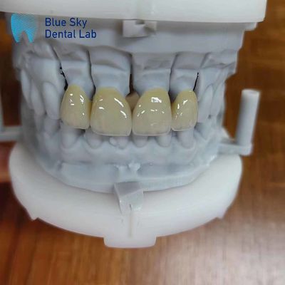 kopen Duurzaam Zirconia gelaagd met porselein Zirconia meerlaagse kroon online manufacture