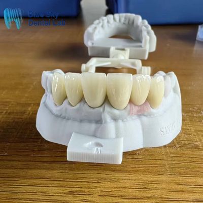 kopen Hoogtranslucent gelaagd Zirconia kroon Natuurlijke kroon met implantaat online manufacture
