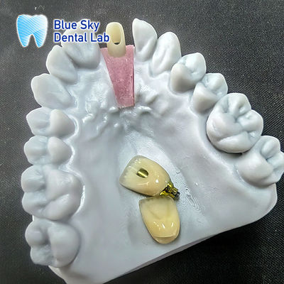 kopen Precieze gefreesde zirconia-abutment met een enkele implantaatkroon online manufacture