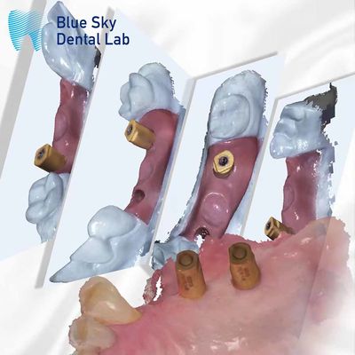 kopen Scan lichaam alles in één tandheelkundige genezing capsule Blue Sky Implantat systeem online manufacture
