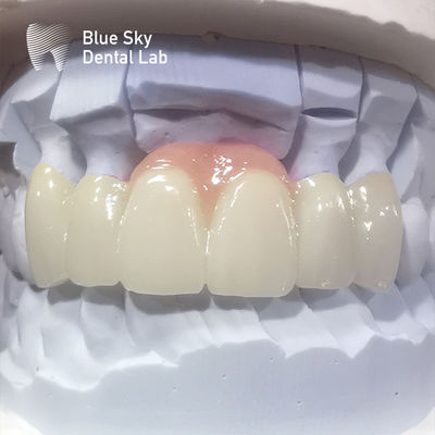 kopen Gelaagde Zirconia kronen Roze porselein Zirconia tandkronen Voor esthetische restauratie online manufacture