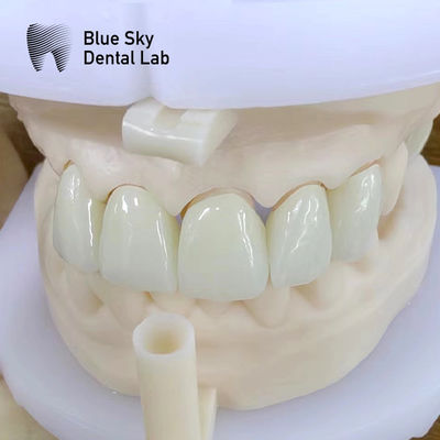 kopen Natuurlijke esthetiek Meerlaagse Zirconia kroon Hoge sterkte Chemische weerstand online manufacture