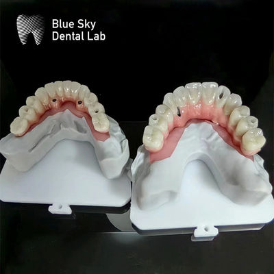 kopen Blue Sky Implantatie Volle Boog Implantatie Cases Natuur Implantatie Cases online manufacture