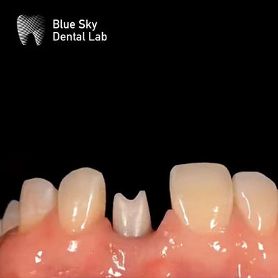 kopen Hypoallergeen tandheelkundig implantaat Zirconia Abutment Biocompatibel online manufacture
