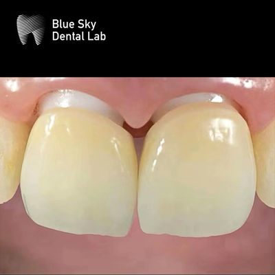 kopen Gelaagd Zirconia Implantat Kroon Zirconia Abutment Biocompatibel online manufacture