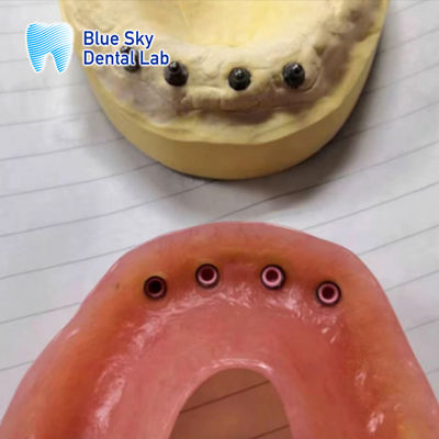 kopen Afneembare implantatenherstel Locator Implantatenprothese Volle mondherstel online manufacture