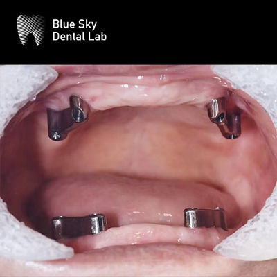 kopen Hars Tanden Tandheelkundige Titanium Bar Afneembare Blue Sky Implantat System online manufacture
