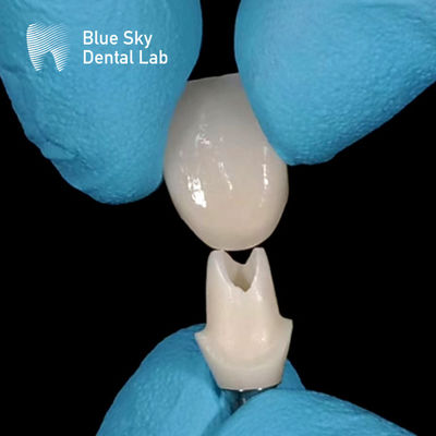 Oral scan Custom Zirconia Abutment Hoogsterkte Zirconia Abutments