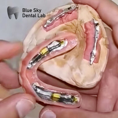 Blue Sky tandheelkundige implantaten met titaniumstaaf voor verwijderbare prothesen