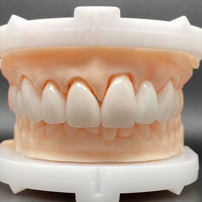 EMax veneer hoesjes passief passen in meerdere kleuren maken een mooie glimlach met minimale tandvoorbereiding